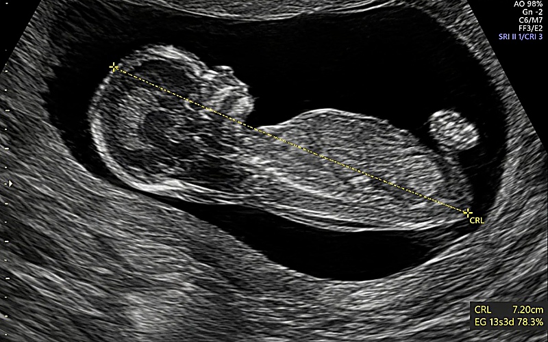 Tamizaje genético prenatal primer trimestre — ecografía fetal de translucencia nucal y medición CRL en Guadalajara